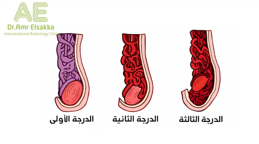 درجات دوالي الخصية بالصور