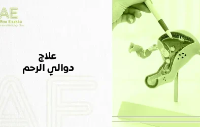 علاج دوالي الرحم بالقسطرة التداخلية