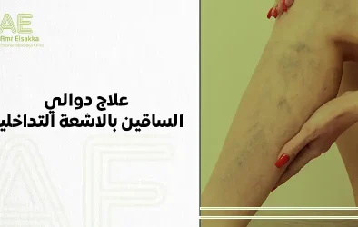 علاج دوالي الساقين بالاشعة التداخلية