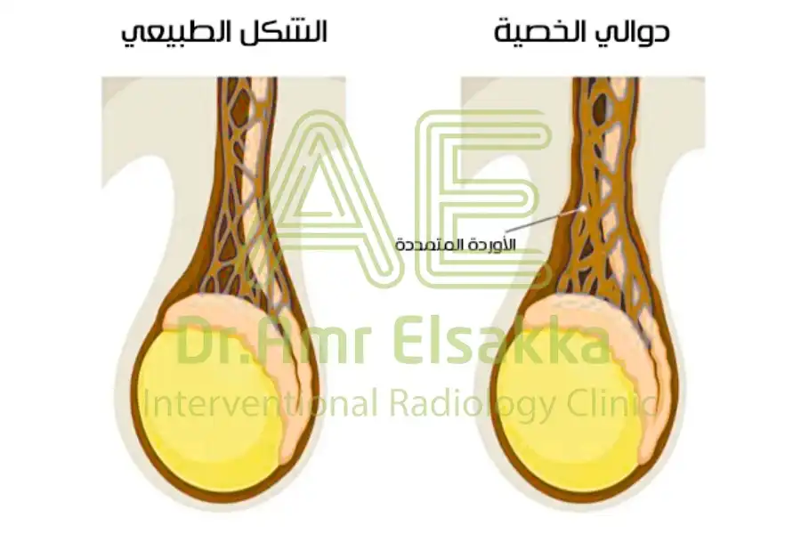 شكل الخصية بعد عملية الدوالي