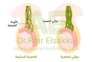 شكل الخصية بعد عملية الدوالي