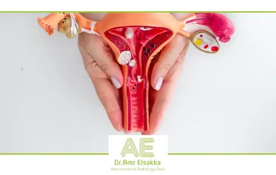 علاج الاورام الليفية في الرحم بالاشعة التداخلية