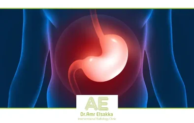 علاج انسداد القنوات المرارية