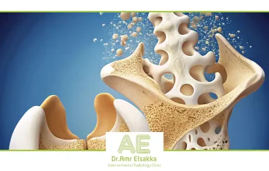 علاج اورام العظام الحميدة