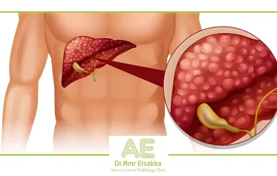 علاج اورام الكبد بدون جراحه