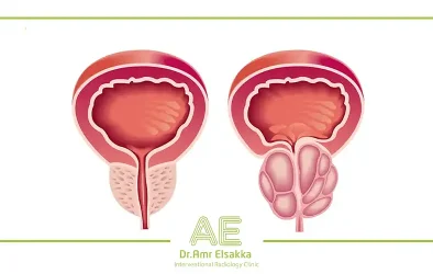 علاج تضخم البروستاتا بدون جراحة