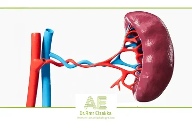 علاج تضخم الطحال بدون جراحة