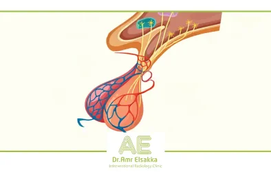 علاج دوالي الخصيه بدون جراحه