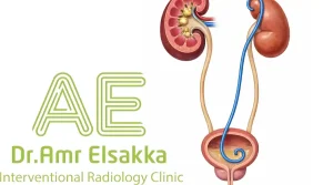 أشكال دعامة الحالب