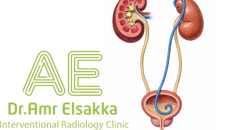 أشكال دعامة الحالب