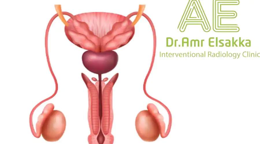 أنواع دوالي الخصية