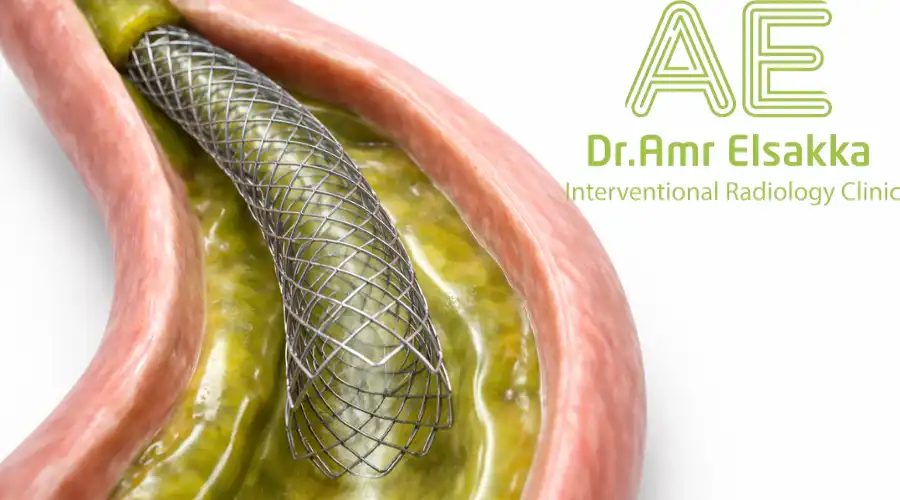 شكل دعامة القناة المرارية