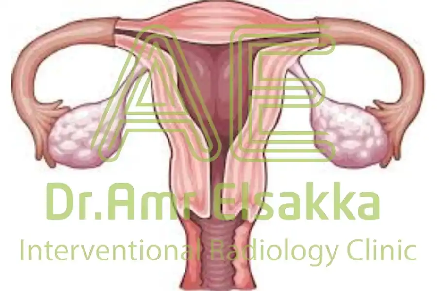 شكل دوالي الحوض عند النساء
