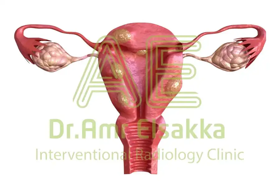 شكل دوالي الرحم