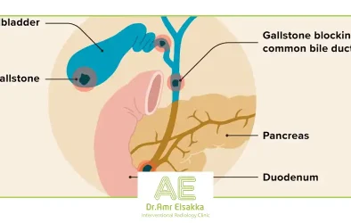 Biliary obstruction treatment