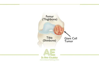 benign bone tumor with thermal cauterization