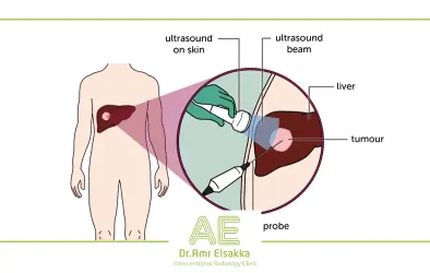 liver tumor treatment with thermal frequency