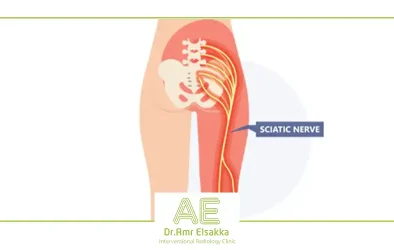 sciatica treatment with thermal frequency