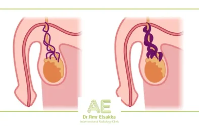 varicocele treatment without surgery