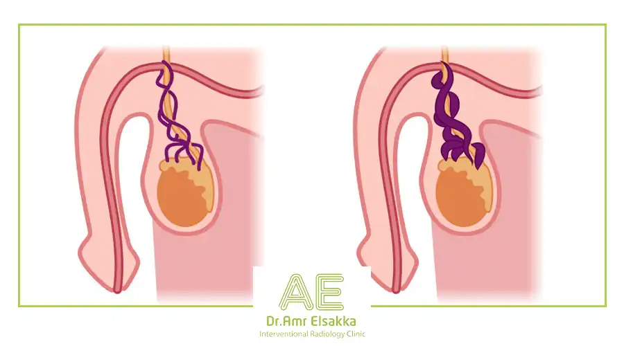 Varicocele treatment without surgery - Dr. Amr El-Sakka