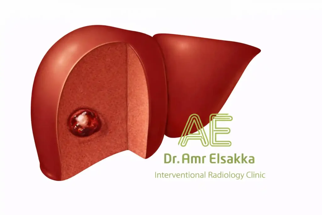 شكل وحمة الكبد