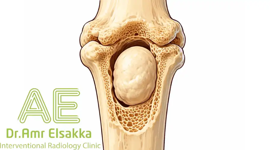 شكل الورم العظمي الحميد 