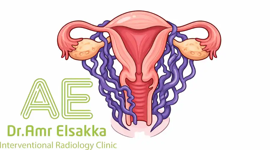 شكل دوالي الرحم