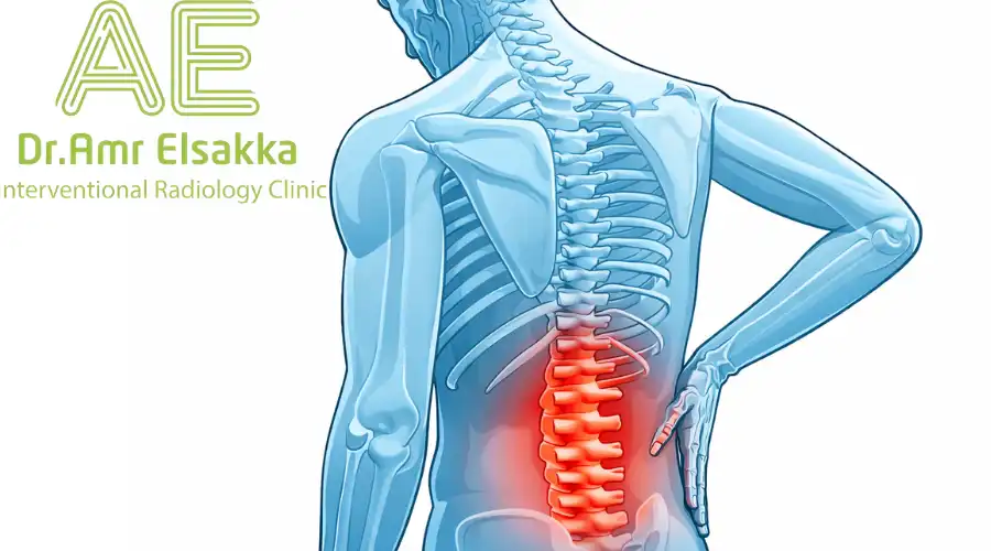 ما هو علاج الغضروف بالتبخير